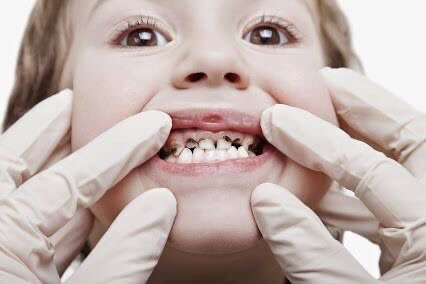 Rampan Karies: Penyebab, Pencegahan, dan Pengobatannya