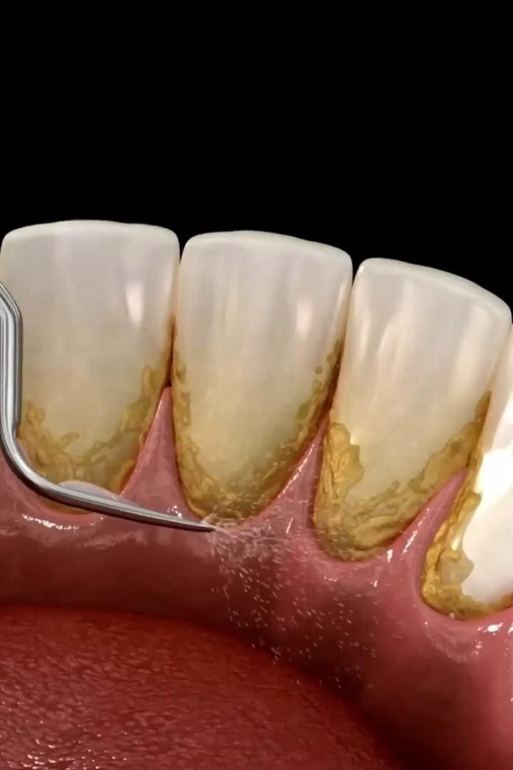 Pembersihan Karang Gigi: Mengapa Penting dan Bagaimana Dilakukan